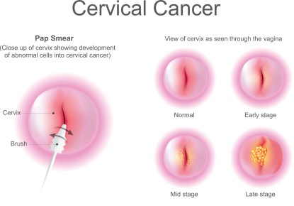 Stage of Cervical cancer. Education info graphic vector.