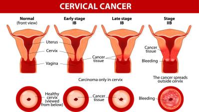 cervix2